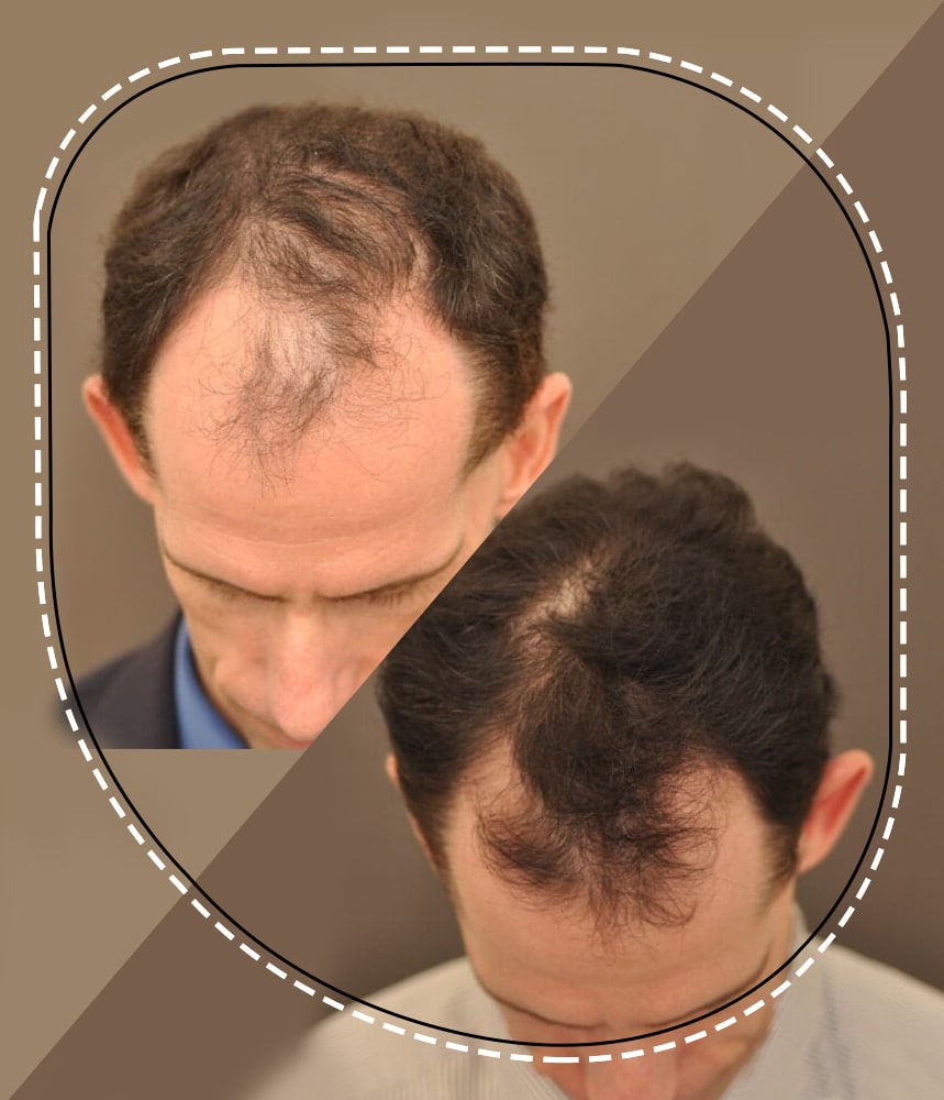 Low level laser therapy for hair - Dr Sajjas Clinic in Tirupati