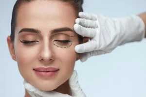 BLEPHAROPLASTY Featured 300x200