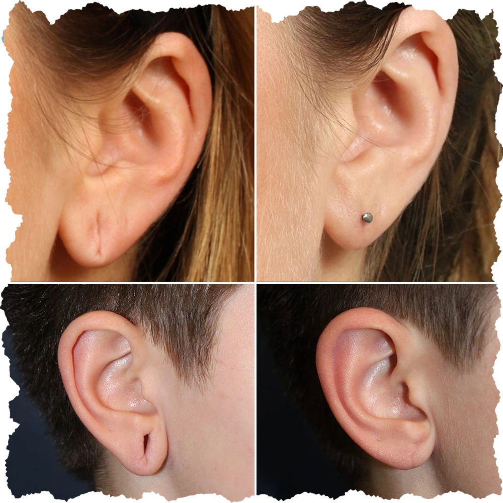 Ear lobe Repair - Dr Sajjas Clinic in Tirupati
