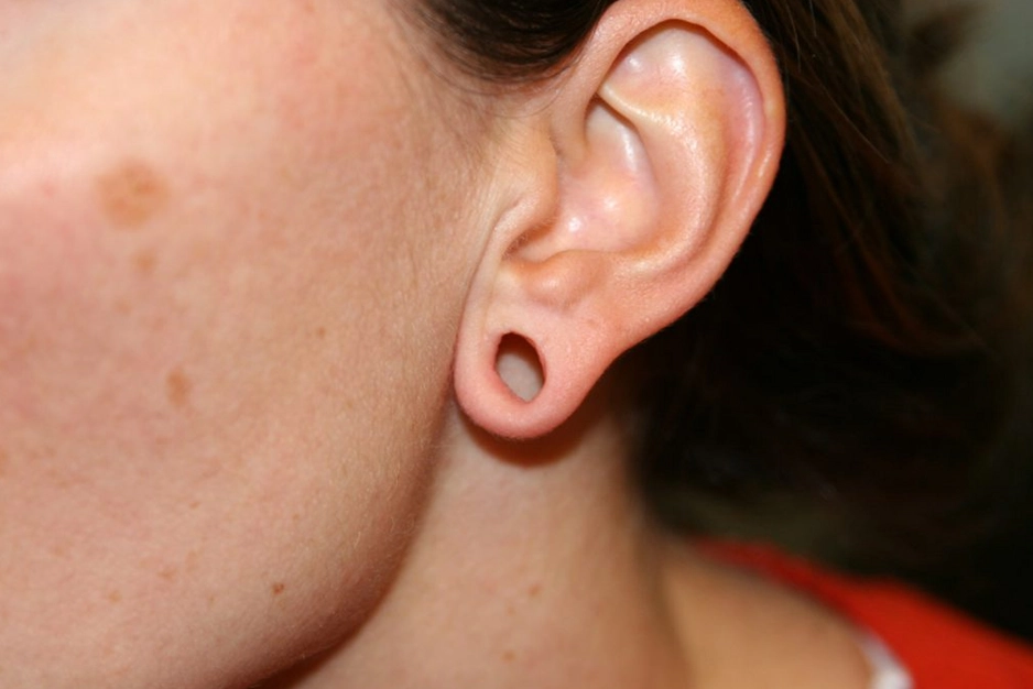 EAR LOBE REPAIR Featured