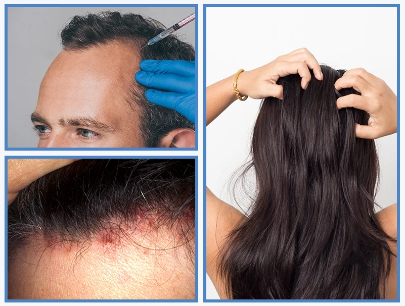 Hair PRP treatment