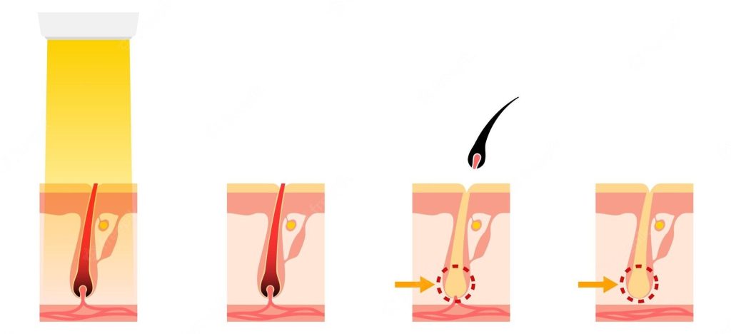 Laser Hair Removal procedure