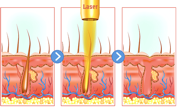 Laser hair removal treatment procedure