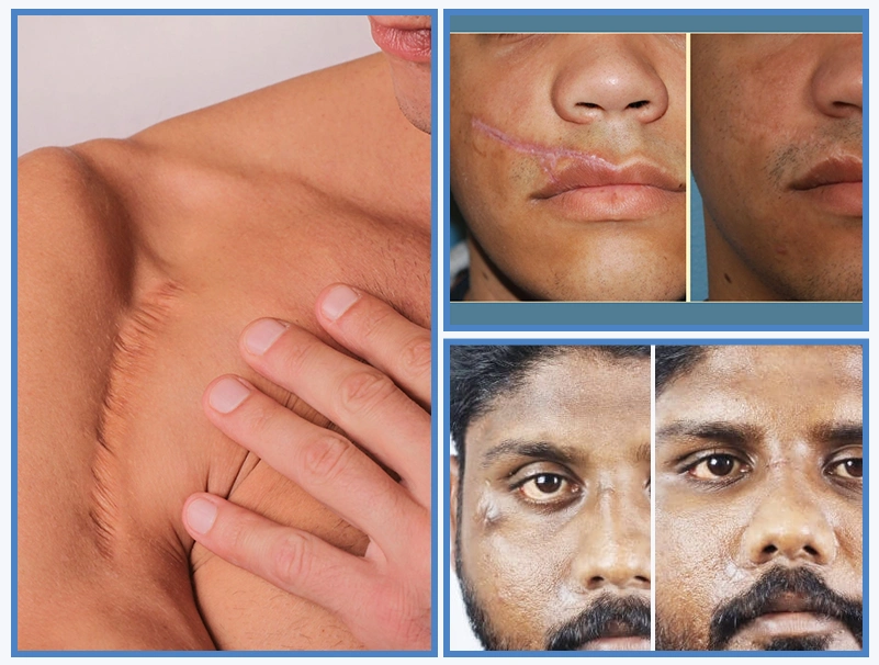 Acne Scar Treatment 2
