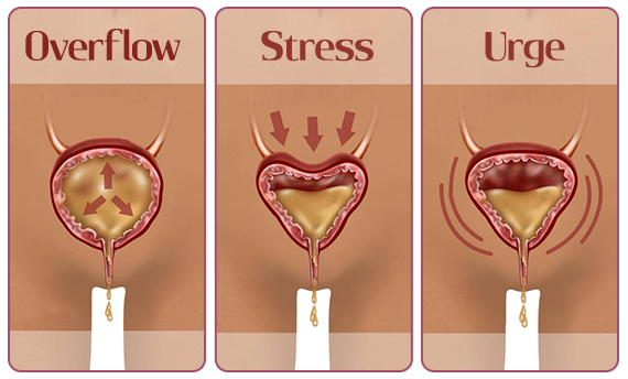 Stress Incontinence 02