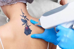 TATTOO REMOVAL Featured 300x200