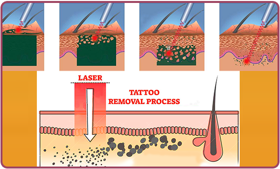 Laser tatoo removal procedure
