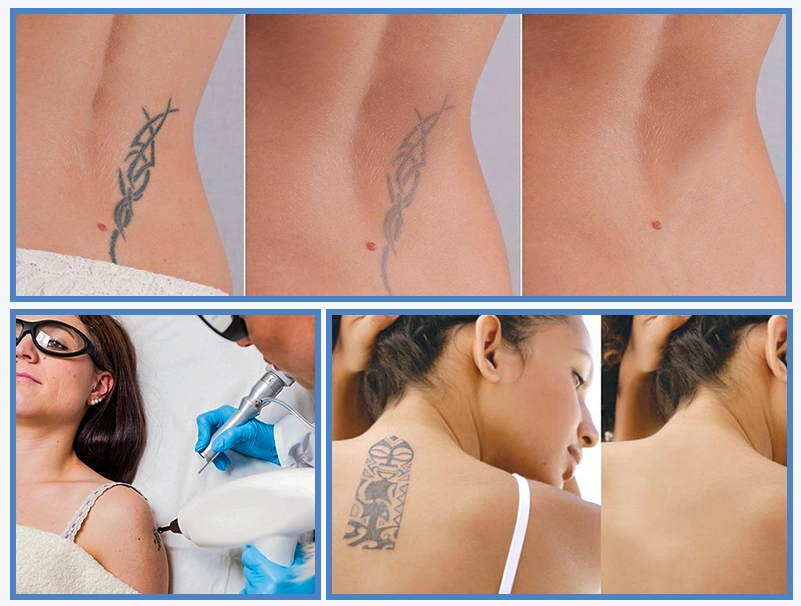 Dealing with tattoos in plastic surgery Tattoo removal  ScienceDirect