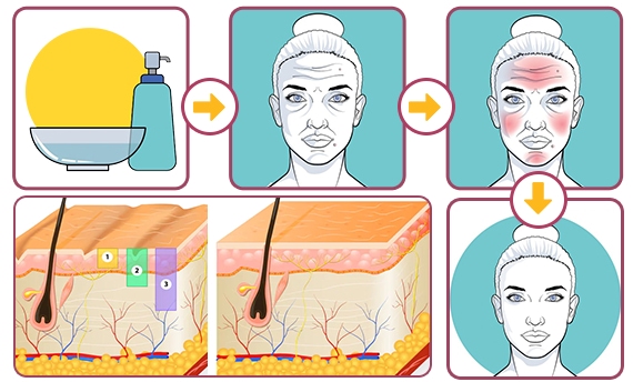 Chemical Peeling procedure