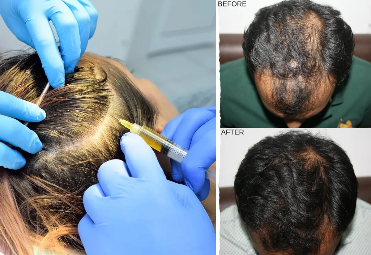 Hair PRP Treatment for Hair Restoration - Dr Sajjas Clinic in Tirupati