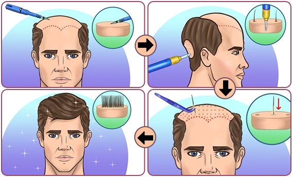 How FUE Hair Transplantation Works? - Dr Sajjas Clinic in Tirupati