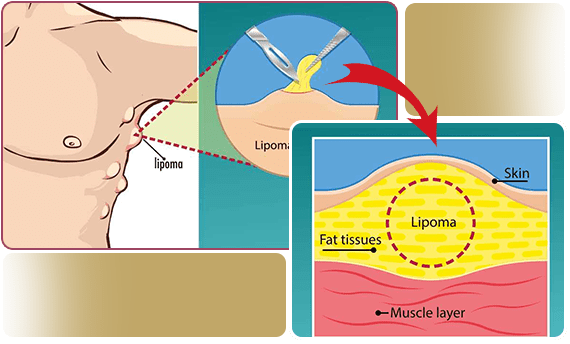 Lipoma removal procedure