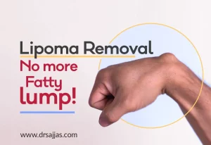 Lipoma Removal