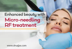 Microneedling treatment