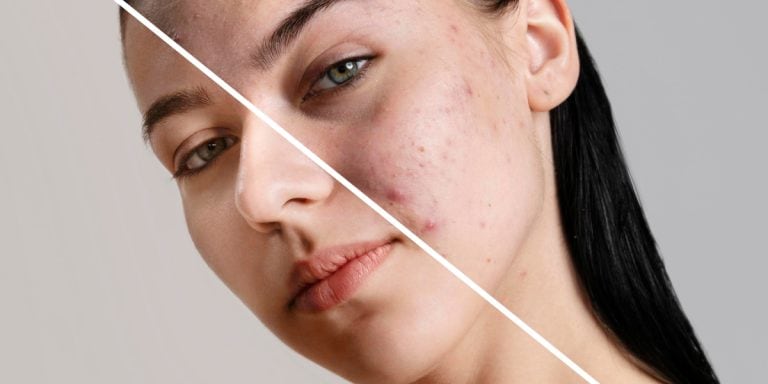 Acne scar treatment