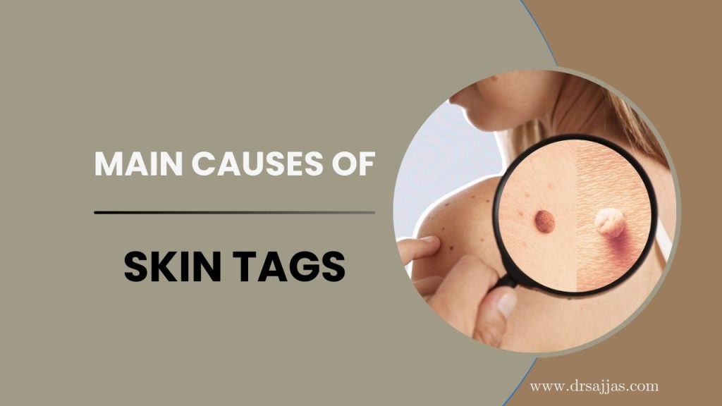 Skin Tag Removal in Tirupati