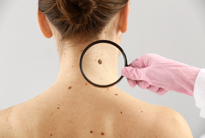 Skin Tag Removal in Tirupati