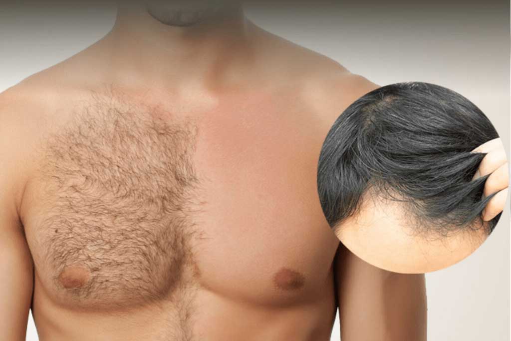 Body Hair Transplantation