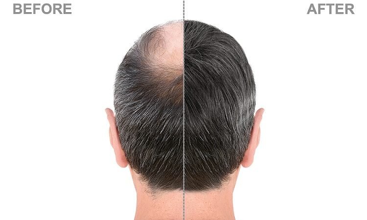 Hair-Transplant