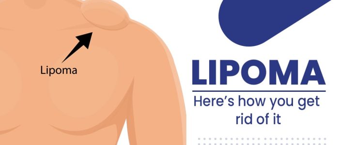 Lipoma Surgery