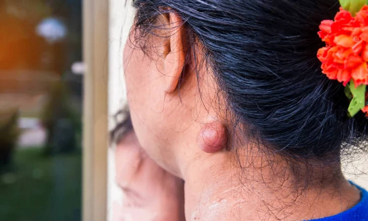 SEBACEOUS CYST-featured