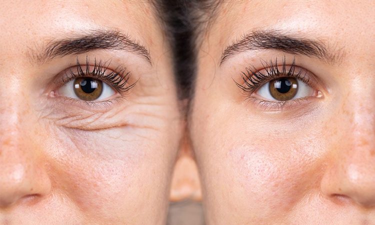 Benefits of Blepharoplasty Surgery