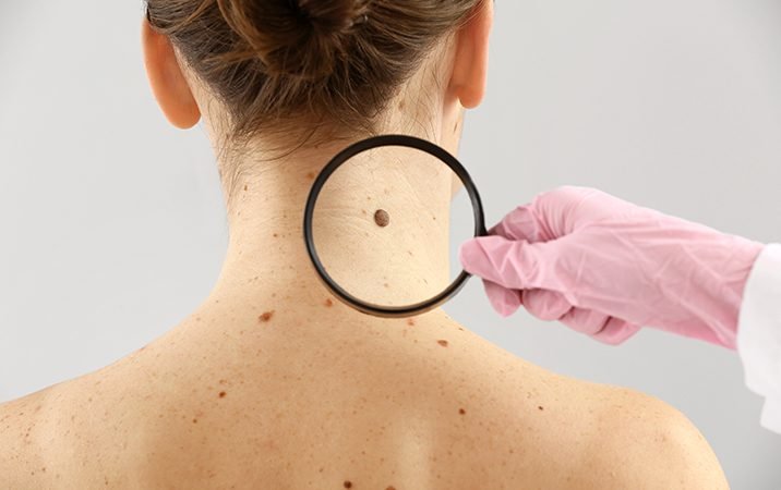 Skin Tag Removal in Tirupati