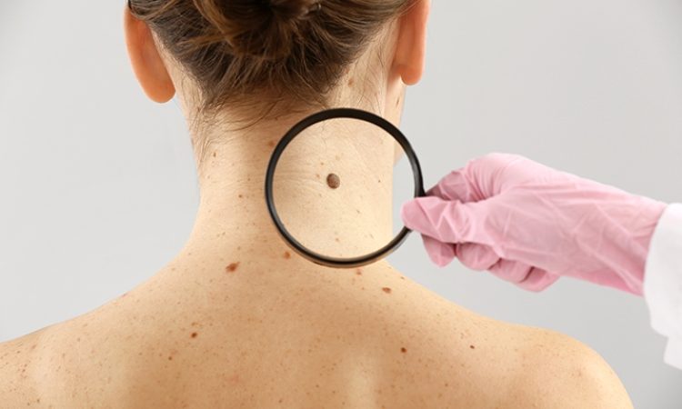 Skin Tag Removal in Tirupati